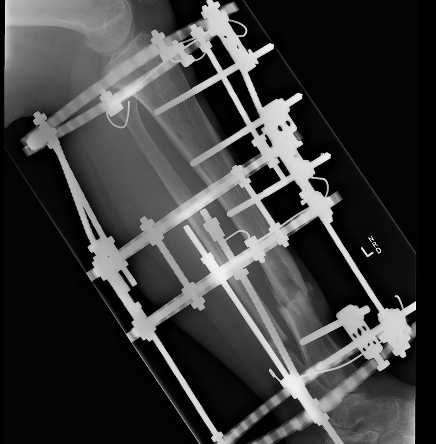 Infected Tibial Non Union Ilizarov Lateral